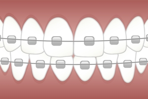 Типове Dental Implants 13