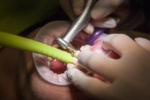Голямо разнообразие Dental Implants 14