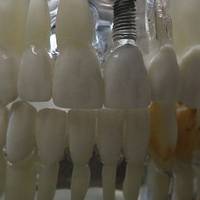 Take a look Dental Implants Bulgaria 22
