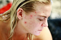 Типове хайфу лифтинг 19 от DermaVita Типове хайфу лифтинг 19