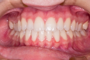 A huge variety of Invisalign 32