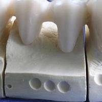 Изключително качествени коронки на зъби 20 от MedicalDent Изключително качествени коронки на зъби 20