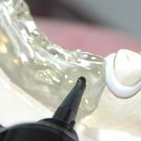 Типове пародонтологично лечение 31 от MedicalDent Типове пародонтологично лечение 31