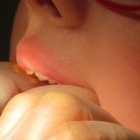 Вижте поставяне на фасети 2 от MedicalDent Вижте поставяне на фасети 2