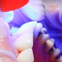 Повече за вадене на мъдрец 34 от MedicalDent Повече за вадене на мъдрец 34