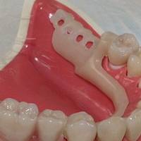 Повече за вадене на ретиниран мъдрец 14 от MedicalDent Повече за вадене на ретиниран мъдрец 14