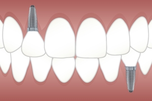 Типове зъбни импланти 40