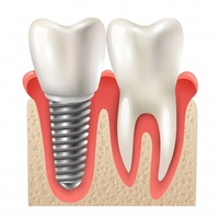 зъбен мост - 58014 - изберете най-добрите