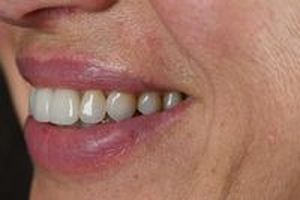 скърцане със зъби - 91356 снимки | Supreme Dental скърцане със зъби - 4544 снимки