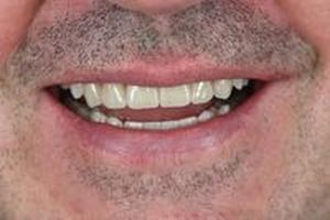 зъбни фасети - 71169 новини | Supreme Dental зъбни фасети - 47679 новини